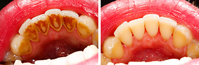 ssmoking teeth stain