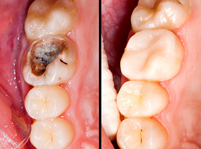 Dental cavity, tooth decay