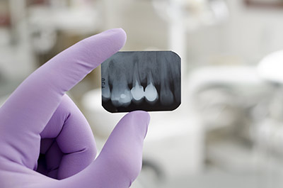 Dental Digital X-Rays gurgaon