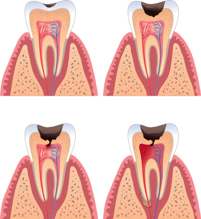 Dental cavity, tooth decay